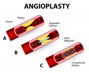 angioplasty-info