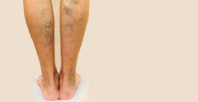 What are Spider Veins?